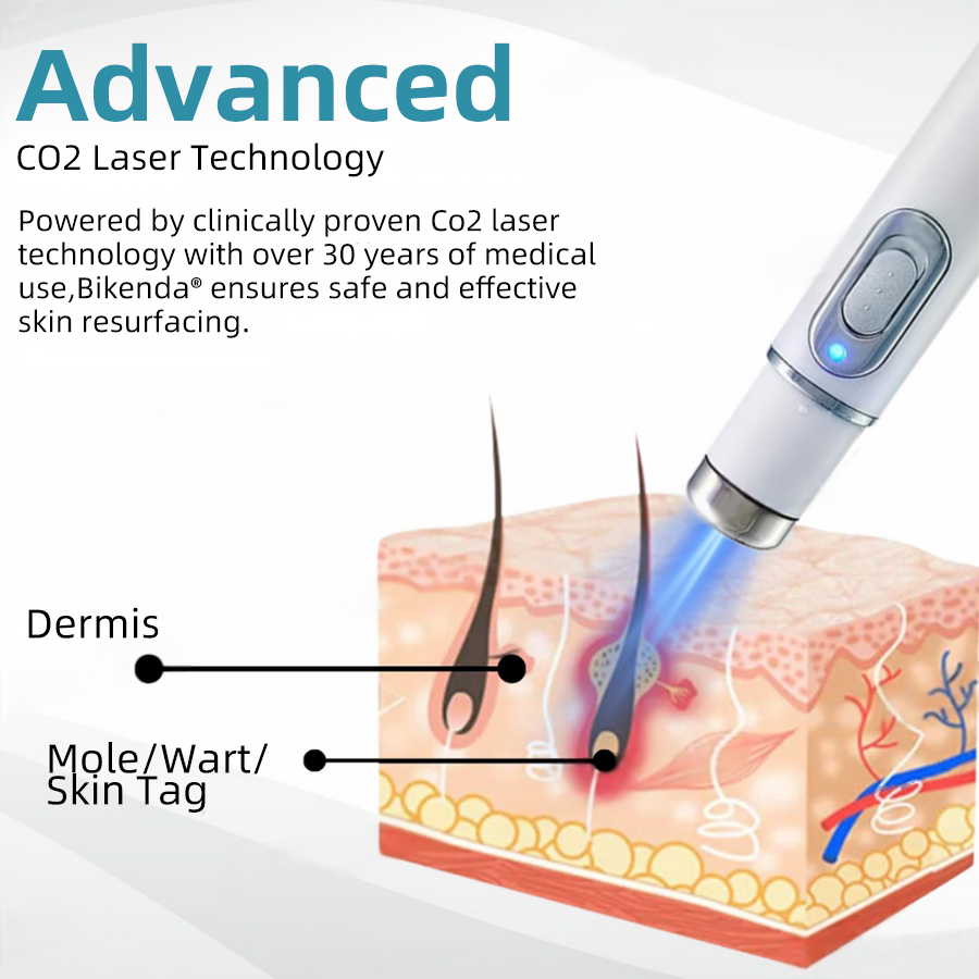 Vermoila® Nicht-invasiver Laserstift zur Entfernung von Muttermalen und Warzen Promax