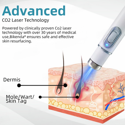 Vermoila® Nicht-invasiver Laserstift zur Entfernung von Muttermalen und Warzen Promax