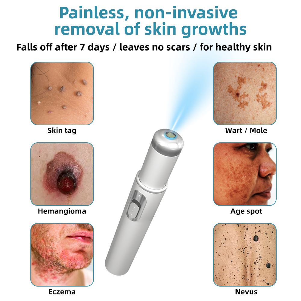Vermoila® Nicht-invasiver Laserstift zur Entfernung von Muttermalen und Warzen Promax