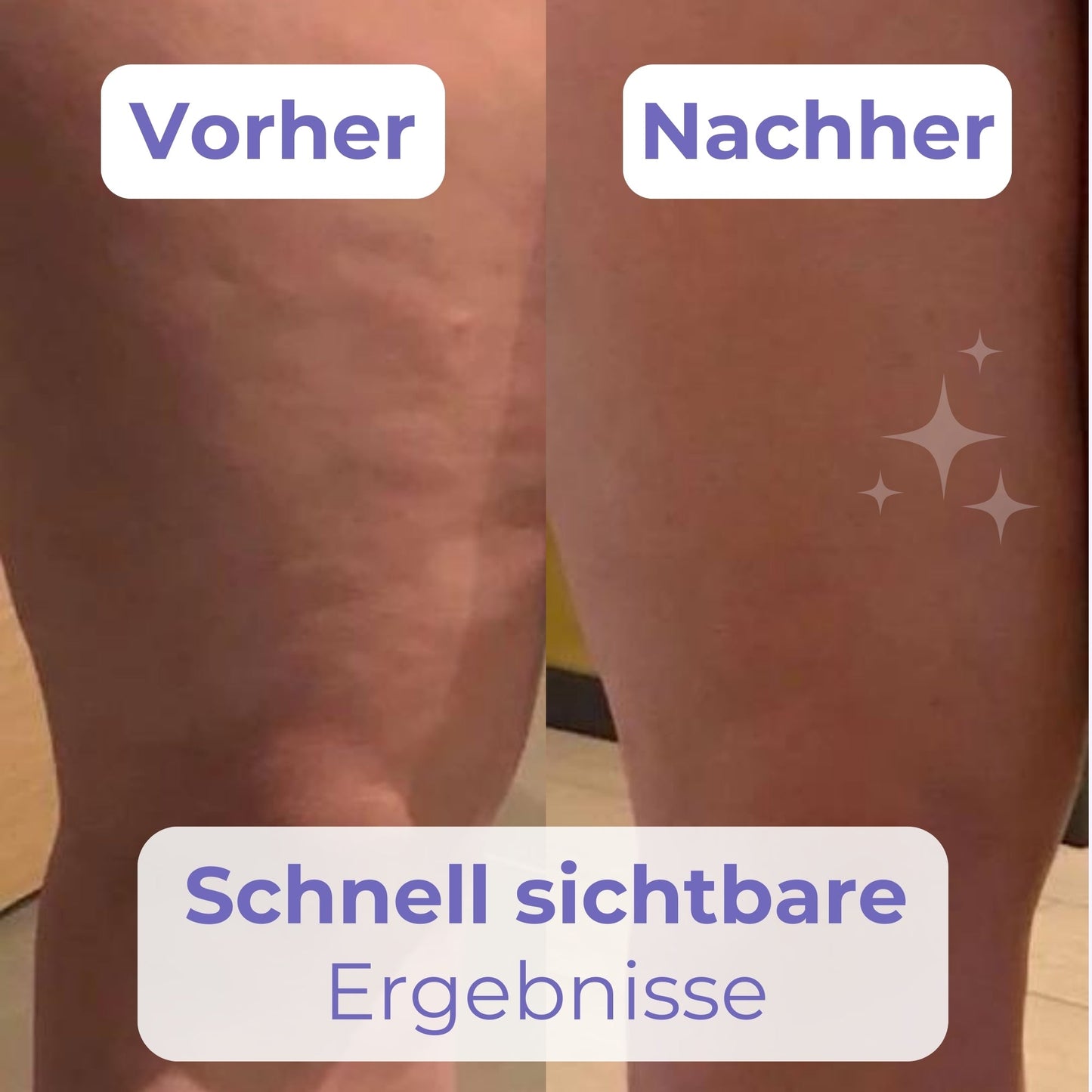 SculptThighs™ – Schlankheits- und Straffungslösung in nur wenigen Wochen