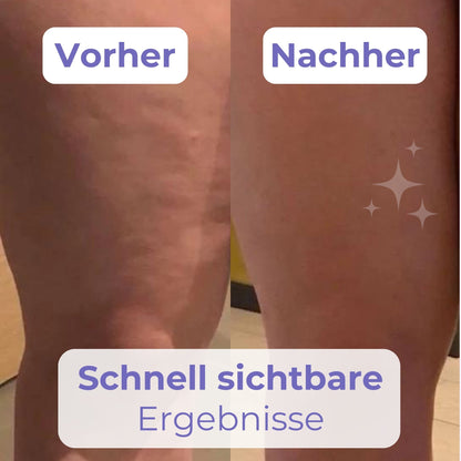 SculptThighs™ – Schlankheits- und Straffungslösung in nur wenigen Wochen