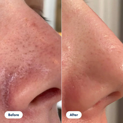 Sanfte Hauterneuerung – Glyssa Rice Peel Duo