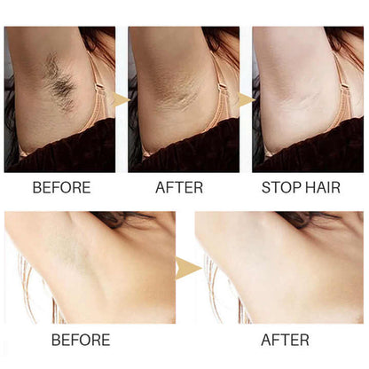 Smoothify™ Dauerhafte Haarentfernung | 1+1 GRATIS
