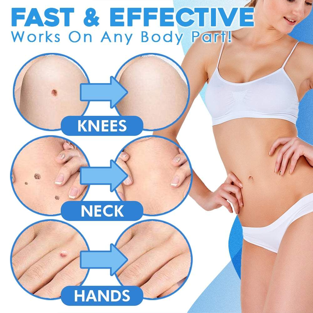 Schmerzlose Entfernung von Hautanhängseln – Auto SKIN TAG Kit mit 50% Rabatt