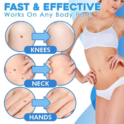 Schmerzlose Entfernung von Hautanhängseln – Auto SKIN TAG Kit mit 50% Rabatt