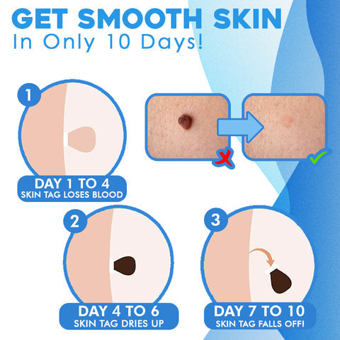 Schmerzlose Entfernung von Hautanhängseln – Auto SKIN TAG Kit mit 50% Rabatt